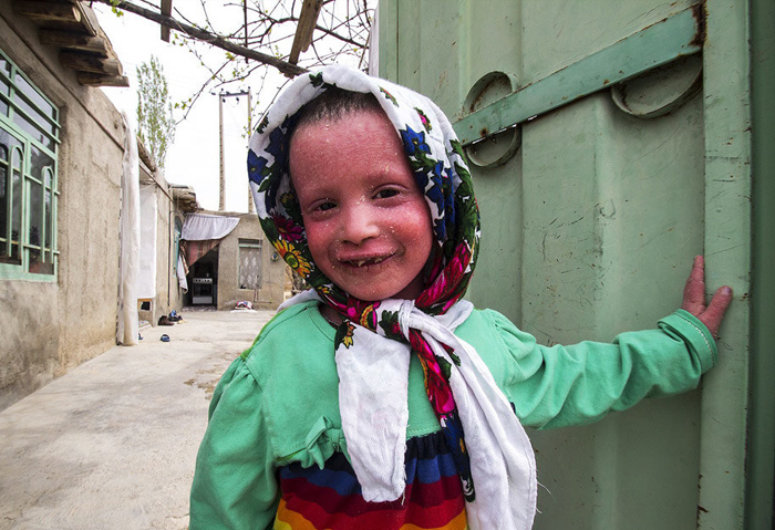 (تصاویر) بیماری پوستیِ نرگس (تصاویر) بیماری پوستیِ نرگس