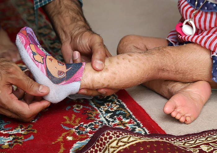 (تصاویر) بیماری پوستی ملیکا (تصاویر) بیماری پوستی ملیکا