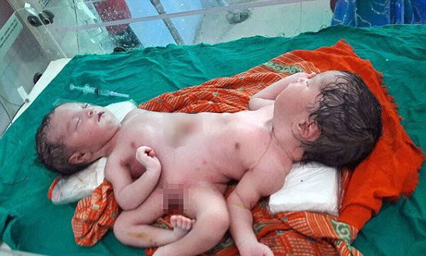 (تصاویر)دوقلوهای به‌هم‌چسبیده هندی