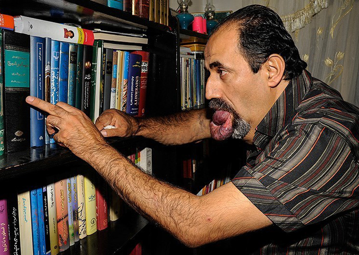 (تصاویر) بیماری دردناک اسماعیل (تصاویر) بیماری دردناک اسماعیل