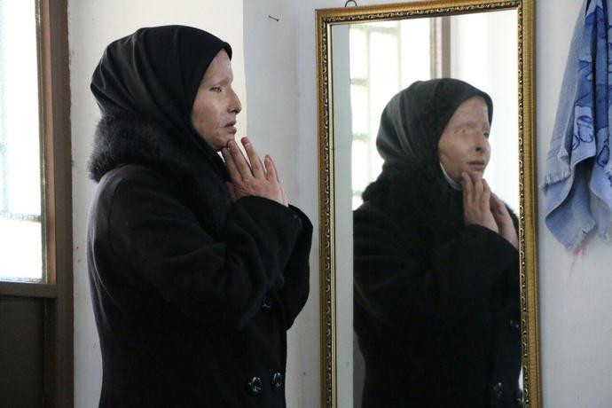 روزگار بد دختر دهدشتی که قربانی اسیدپاشی شد روزگار بد دختر دهدشتی که قربانی اسیدپاشی شد