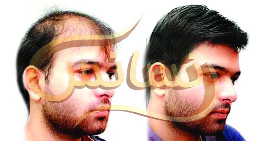 از سیر تا پیاز کاشت مو و کاشت ریش