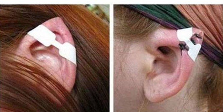 جراحی‌های گوش الاغی و چشم‌گربه‌ای قابل تعقیب کیفری است