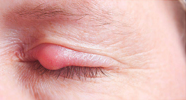 همه چیز دربارهی گلمژه؛ از علل ایجاد تا درمان همه چیز دربارهی گلمژه؛ از علل ایجاد تا درمان