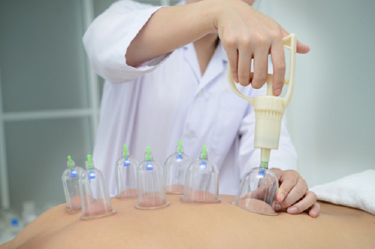 حجامت چیست؟ بایدها و نبایدهای حجامت