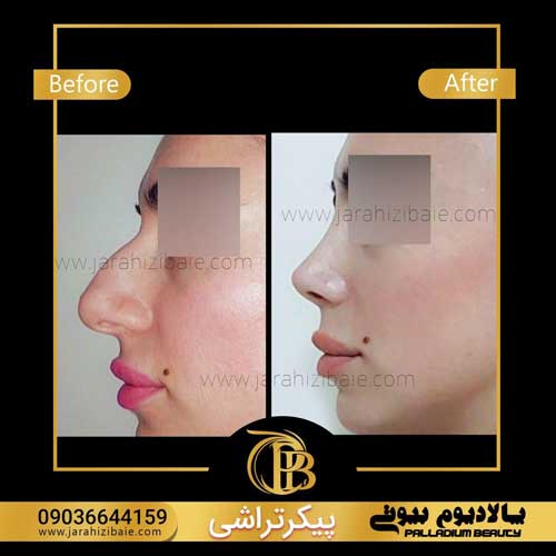 عمل بینی یا جراحی بینی چند نوع است و آیا همه می توانند انجام دهند؟
