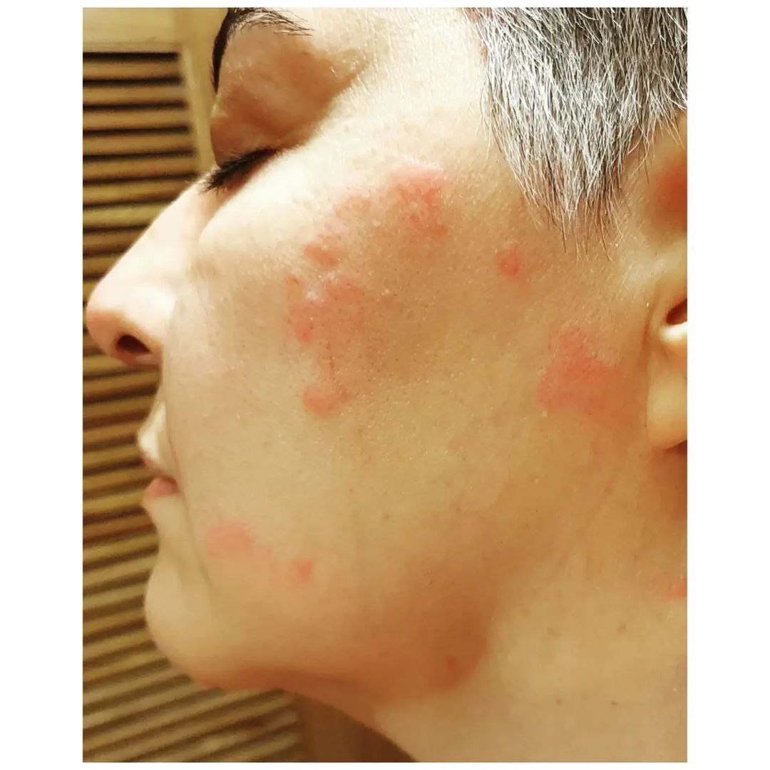 عکس‌هایی از بیماری آناهیتا همتی در اثر آلودگی هوای تهران