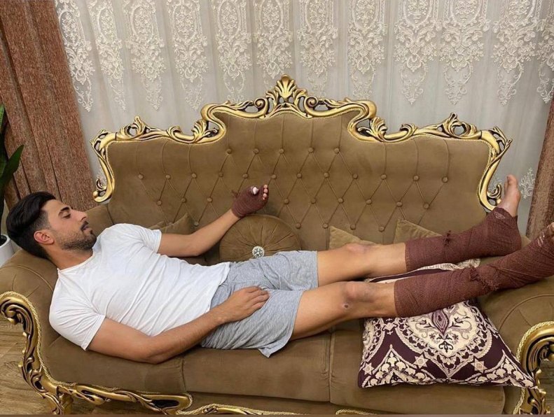 (عکس)سوختگی&nbsp;شدید بازیکن داماش بعد از نجات همسابه در آتش