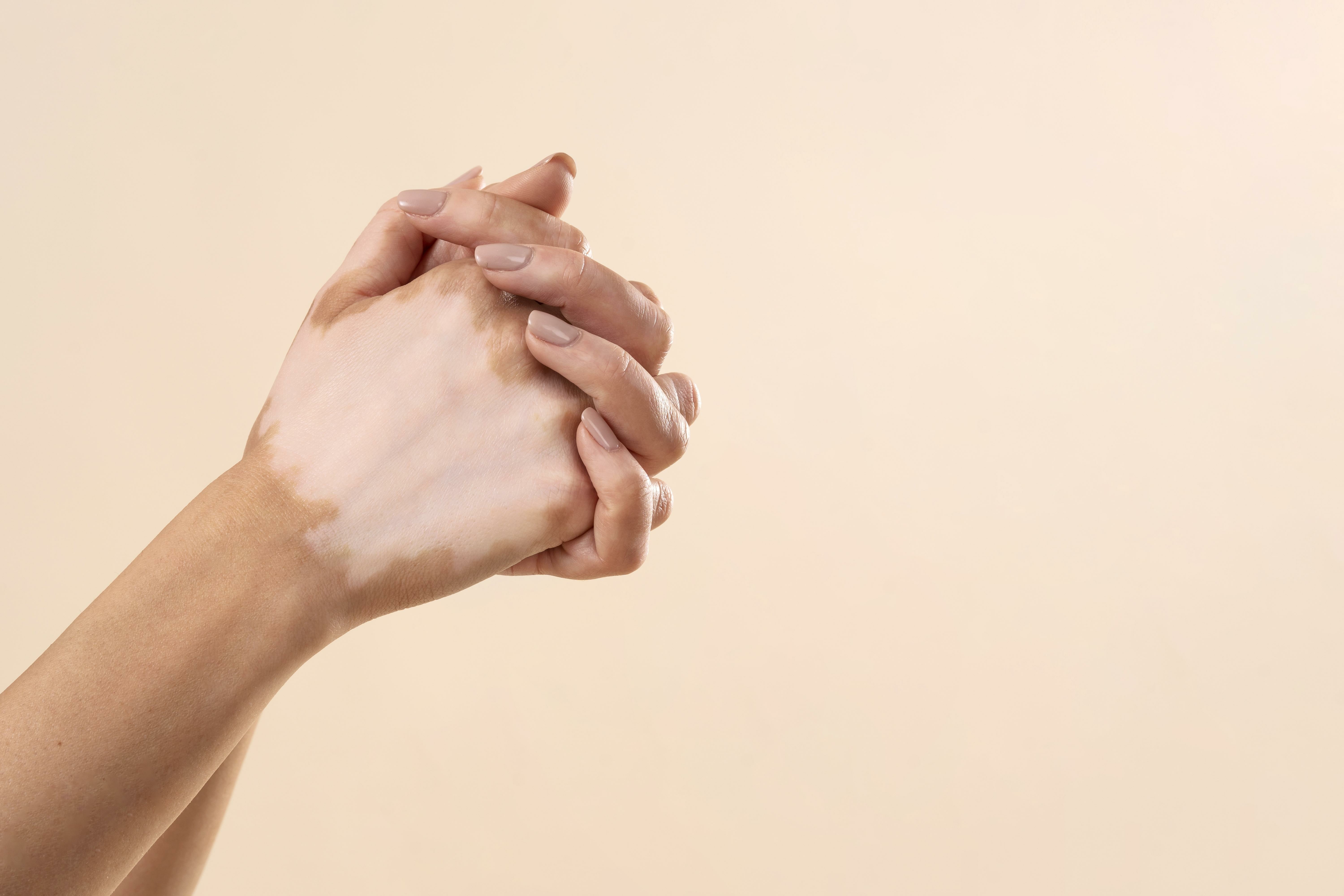 ویتیلیگو، بیماری پوستی عجیب و غریب//ترجمه