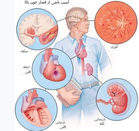 فشارخون بالا؛ علائم و راه‌های درمان