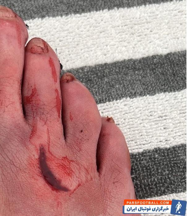 (عکس) بنزما با پای زخمی ۹۰ دقیقه بازی کرد