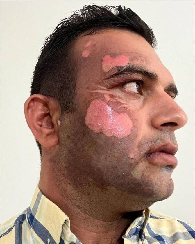 (تصویر) سوزاندن صورت یک محیط‌ بان توسط یک شکارچی